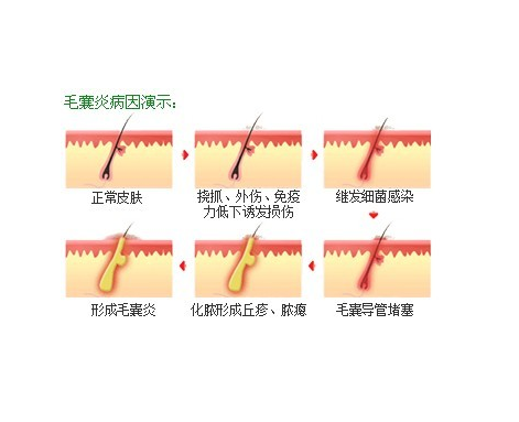 银屑病人生活很恶心